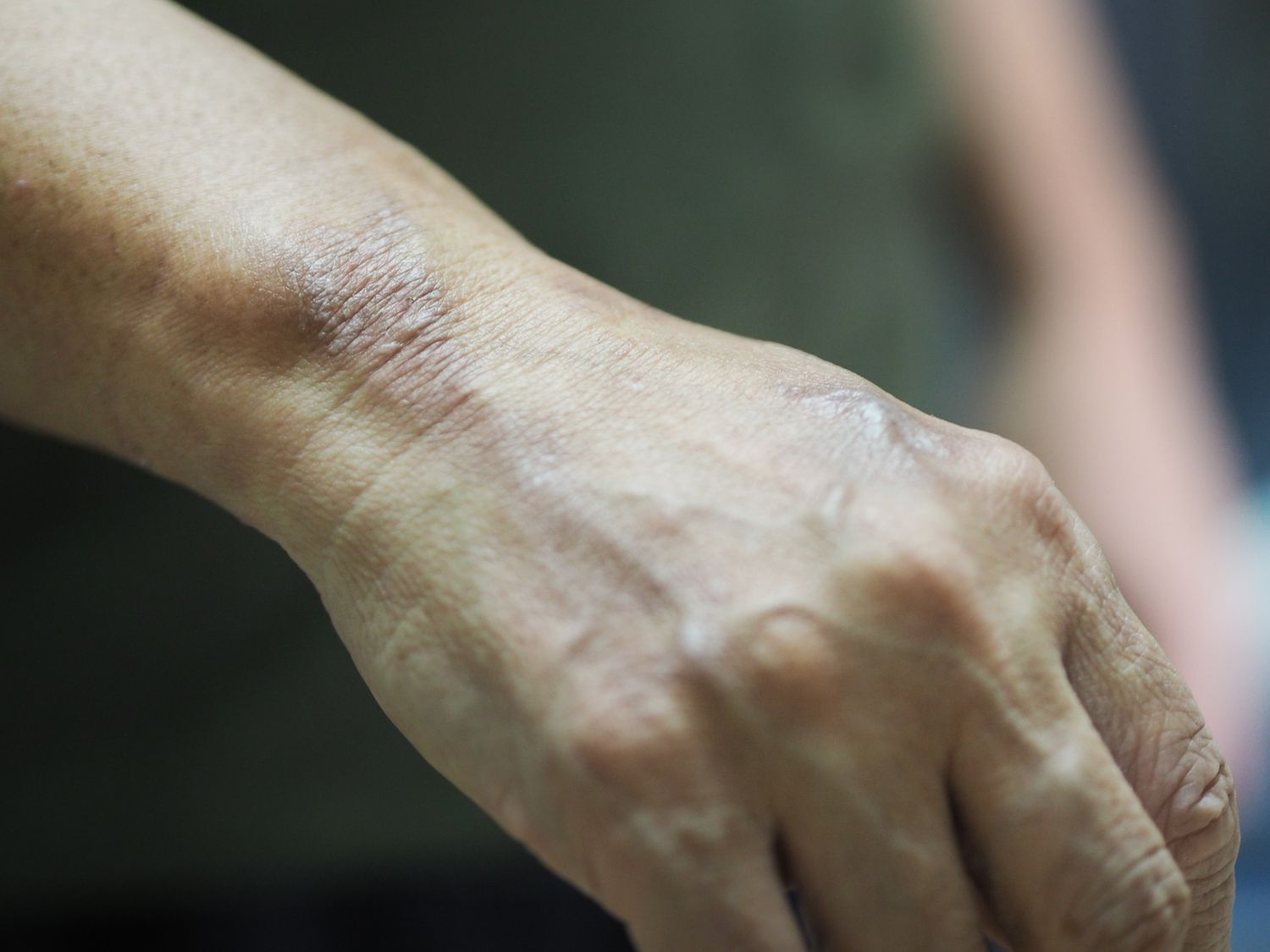 Leprosy – Scaly Skin Disease