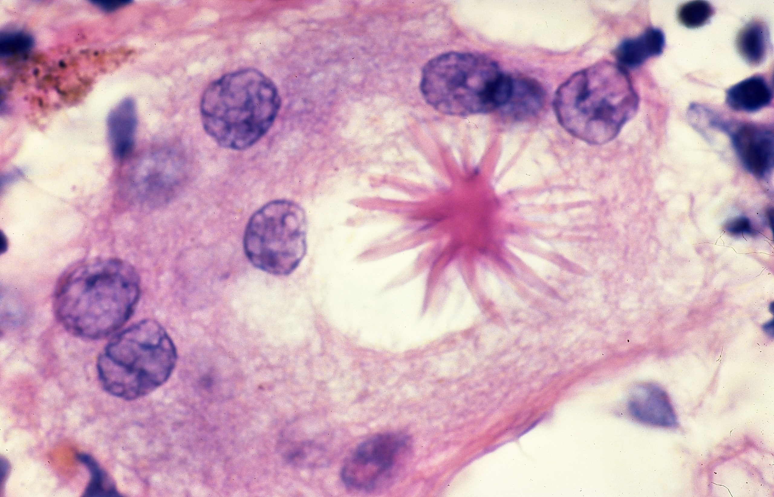 Sarcoidosis – the Diagnosis of Exclusion