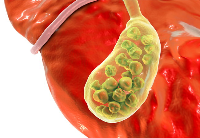 Cholecystitis