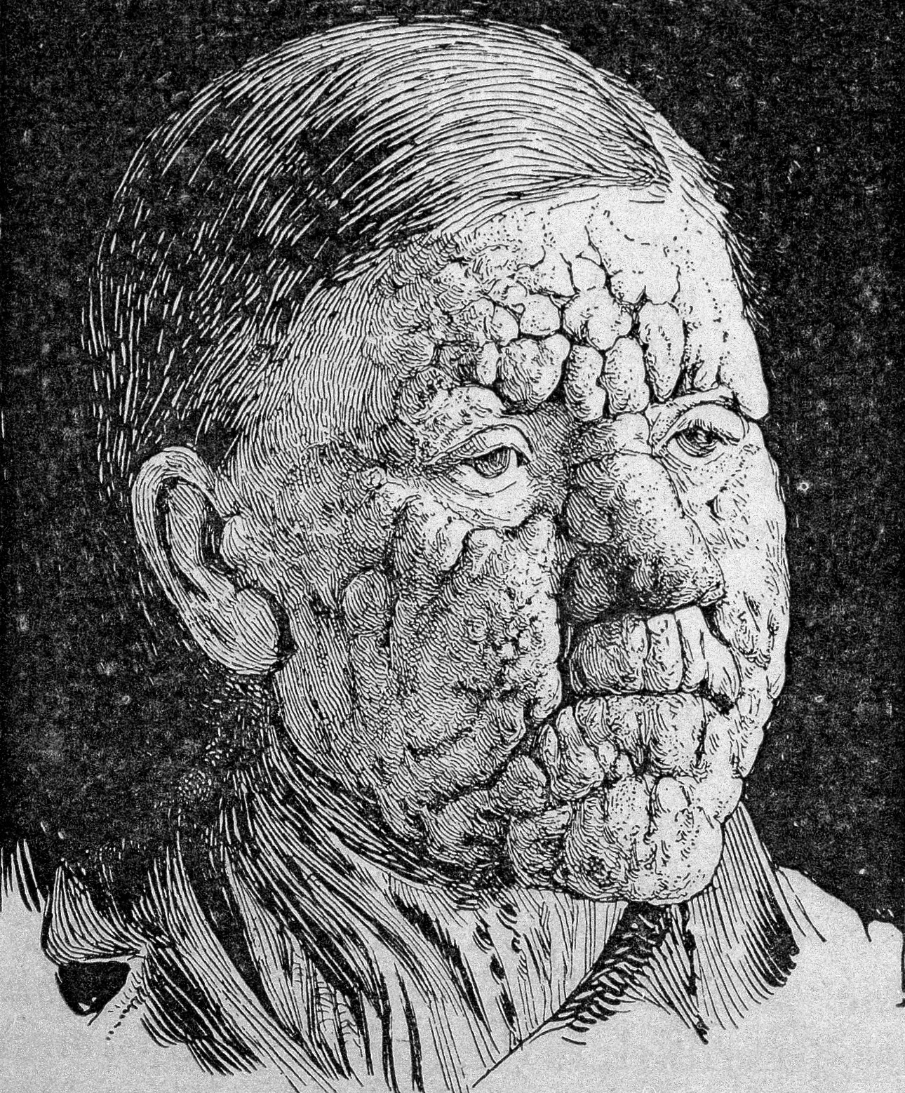 Leprosy – Scaly Skin Disease
